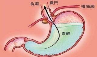 胃酸怎么办 缓解胃酸的三个方法