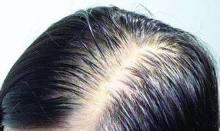油脂性脱发怎么办 ，以下方法让你重新生发