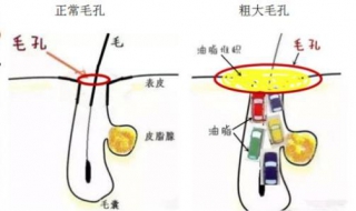 脸上毛孔粗怎么办 ，推荐两种方式解决