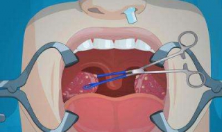 扁桃体发炎怎么办 治疗方法总结如下