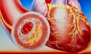 动脉硬化怎么办 请记住这4点有用方法