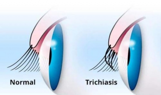 眼睫毛倒长怎么办 四种情形及解决方法