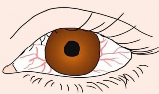 眼睛有红血丝怎么办 消除的几种方法推荐