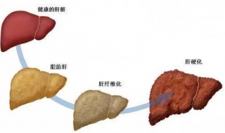 脂肪肝怎么办 适当增加运动