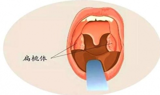 扁桃体有炎症怎么办 5周岁以下儿童 多采用保守治疗