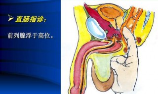 直肠指检正常能排除前列腺癌吗 了解前列腺癌确诊的办法