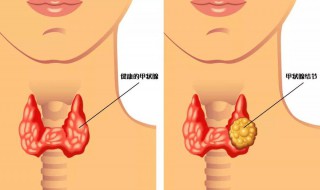 左甲状腺结节有什么症状 快来了解一下吧