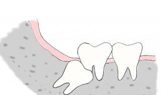 横生智齿和阻生智齿的区别 两者有什么不同