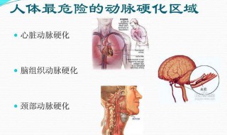 消除颈动脉堵塞方法 颈动脉堵塞处理方法