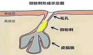 如何有效应对毛孔堵塞 毛孔堵塞产生的原因