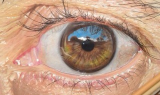如何去除眼部皱纹 什么是眼部皱纹