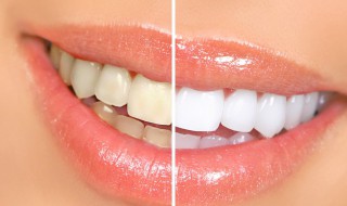 牙齿变白的有效方法窍门 牙齿变白小妙招