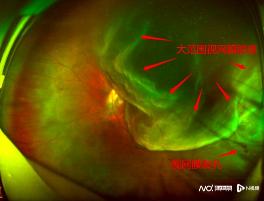 近视2000度的孕妇左眼突然看不清了，原因是……