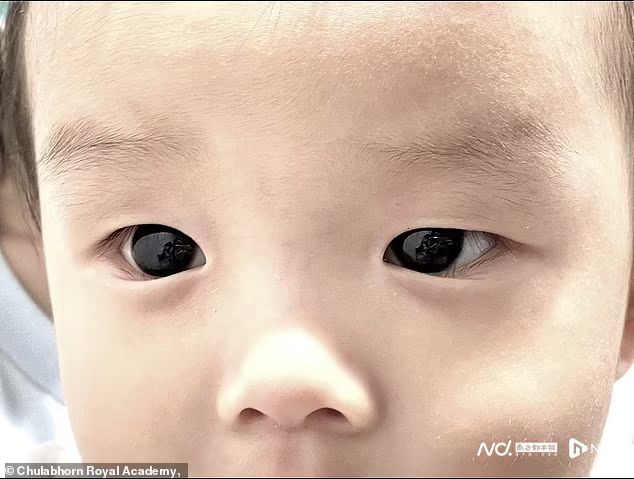 泰国半岁男婴用药治疗新冠，深褐眼睛竟然一夜之间变成亮蓝色