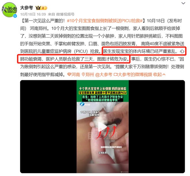 10月龄宝宝因为拔倒刺住进PICU，倒刺不能拔，那该怎么办？