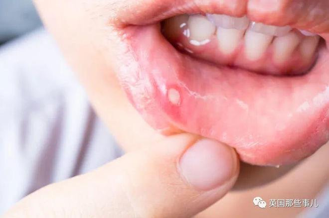 孕妇吃饭时咬到嘴唇，竟长成肿瘤长达4个月？！医生：过于罕见！