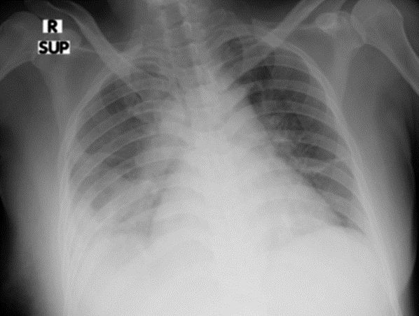 产后患者呼吸困难伴胸痛，凶险感染+肺栓塞！一波三折！